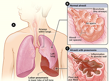 โควิดกินปอด : การเกิดปอดอักเสบ