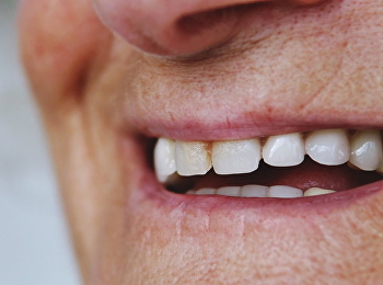 “ผู้สูงอายุ” กับปัญหาสุขภาพช่องปาก
แนะลดกินอาหารหวาน-เหนียว